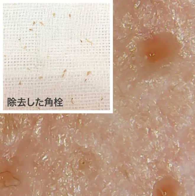ニキビ治療のビフォーアフター